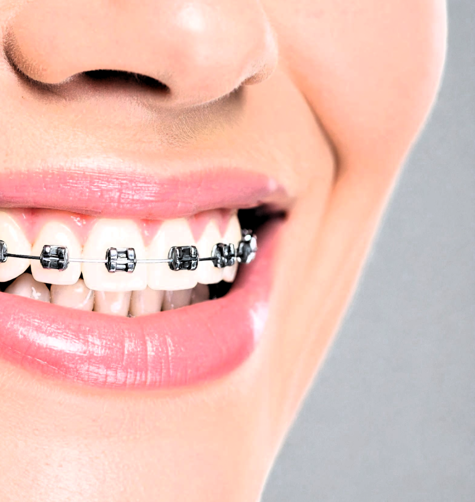 common myths about braces